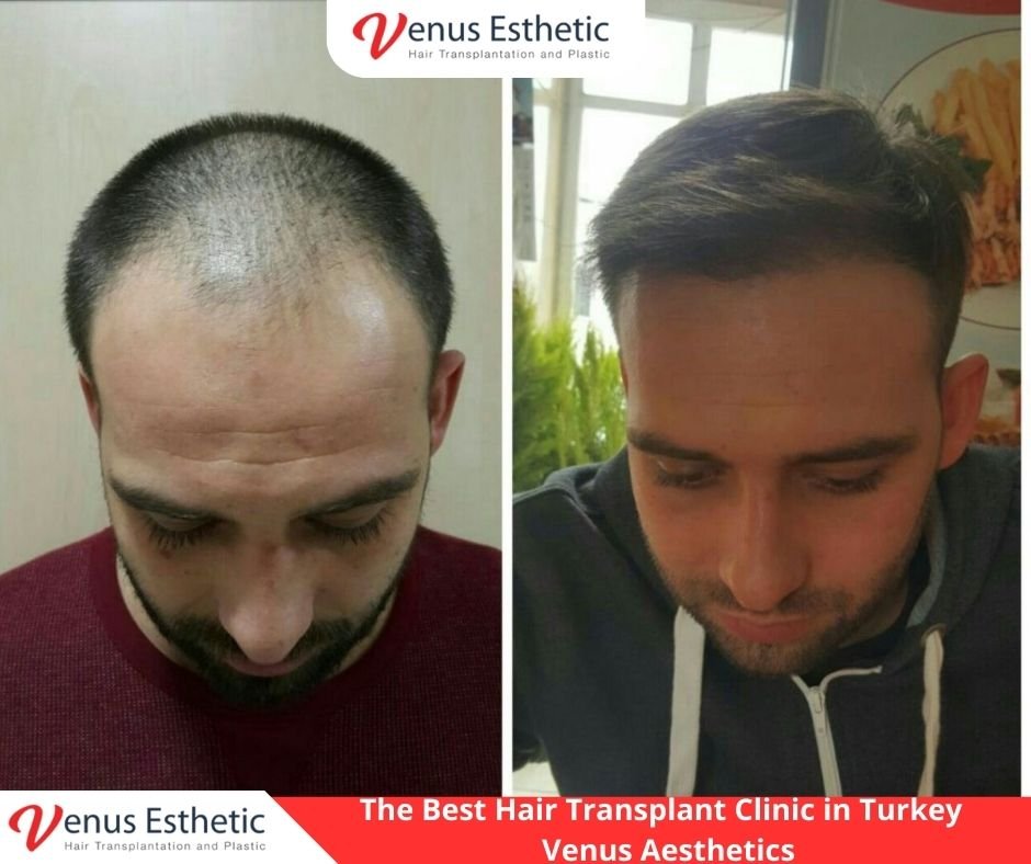 The Best Hair Transplant Clinic in Turkey - Venus Aesthetics - Venus  