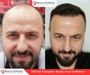 Hair Plantation, Hairline Transplant Cost, hair transplant, hair transplant turkey, venus hair transplant, euro zen hair, best doctor in turkey, best clinic in turkey, hair transplant result, clinic expert, hair transplant, hair transplant uk, dr serkan aygin, hair transplant surgery, dr cinik, dr zen hair, best doctor in turkey, usa hair transplant, dr zen, euro hair transplant, hair transplant cost, hair transplant in usa, hair transplant in uk, hair transplant in australia, hair transplant australia, hair replacement cost, UK vs Turkey Hair Transplant Procedures, venus esthetic clinic, best hair transplant doctor in turkey, turkish hair transplant, Hair Transplants in Turkey, neograft hair transplant near me, hairline transplant, hair plugs cost, fue hair transplant