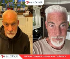 Hair Plantation, Hairline Transplant Cost, hair transplant, hair transplant turkey, venus hair transplant, euro zen hair, best doctor in turkey, best clinic in turkey, hair transplant result, clinic expert, hair transplant, hair transplant uk, dr serkan aygin, hair transplant surgery, dr cinik, dr zen hair, best doctor in turkey, usa hair transplant, dr zen, euro hair transplant, hair transplant cost, hair transplant in usa, hair transplant in uk, hair transplant in australia, hair transplant australia, hair replacement cost, UK vs Turkey Hair Transplant Procedures, venus esthetic clinic, best hair transplant doctor in turkey, turkish hair transplant, Hair Transplants in Turkey, neograft hair transplant near me, hairline transplant, hair plugs cost, fue hair transplant