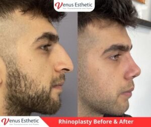 rhinoplasty, rhinoplasty near me, non surgical rhinoplasty, nose job near me, nose jobs, liquid rhinoplasty, non surgical rhinoplasty near me, non surgical rhinoplasty near me, nose plastic surgery, liquid rhinoplasty near me, nose thread lift, nose job price, liquid nose job, nose fillers, nose fillers near me, nose surgeons near me, liquid nose job near me, nose reconstruction surgery, closed rhinoplasty, septorhinoplasty, nose plastic surgery cost, non invasive nose job, venus turkey, venus esthetic clinic, Plastic Surgery, Rhinoplasty, Brazilian butt lift, botox, nose job istanbul, rhinoplasty istanbul, nose surgery istanbul, rhinoplasty turkey istanbul, best doctor in turkey, venus rihnoplasty, venus clinic turkey, best rhinoplasty doctor in turkey, best rhinoplasty doctor in usa, best rhinoplasty doctor in uk, venus esthetic clinic, vera clinic, turkeyana clinic, olcay saygin, dr zen hair, dr cinik, venus clinic turkey, Brazilian butt lift usa, Brazilian butt lift uk, Brazilian butt lift turkey, Brazilian Butt Lift, best Brazilian Butt Lift doctor in usa, best Brazilian Butt Lift doctor in uk, best Brazilian Butt Lift doctor in turkey, best Brazilian Butt Lift doctor in australia, best Plastic Surgery doctor in Turkey, best Plastic Surgery doctor in usa, best Plastic Surgery doctor in uk, best clinic in Turkey, best clinic in usa, best clinic in uk, best doctor in usa, best doctor in uk, best doctor in canada