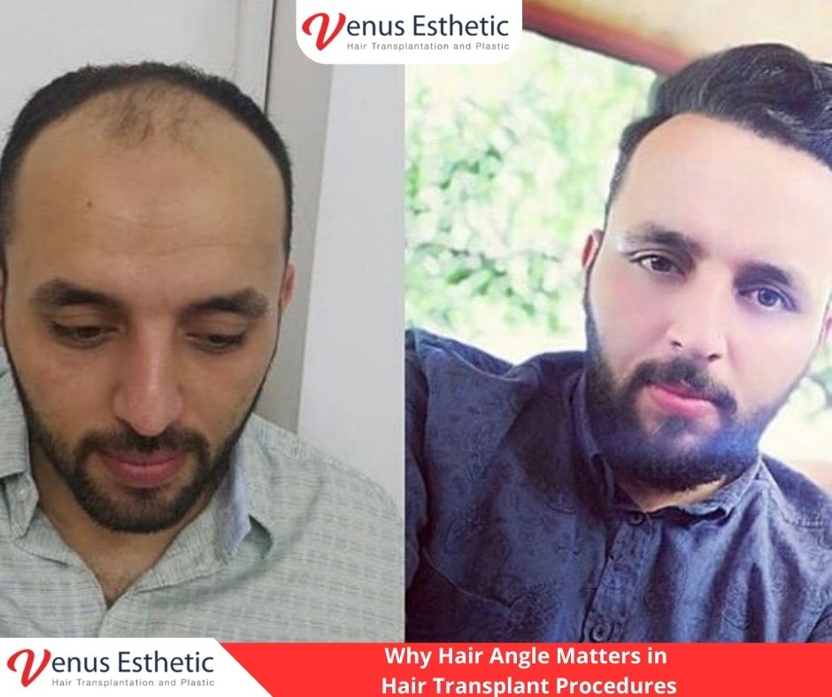 Hair Angle, Hair Plantation, Hairline Transplant Cost, hair transplant, hair transplant turkey, venus hair transplant, euro zen hair, best doctor in turkey, best clinic in turkey, hair transplant result, clinic expert, hair transplant, hair transplant uk, dr serkan aygin, hair transplant surgery, dr cinik, dr zen hair, best doctor in turkey, usa hair transplant, dr zen, euro hair transplant, hair transplant cost, hair transplant in usa, hair transplant in uk, hair transplant in australia, hair transplant australia, hair replacement cost, UK vs Turkey Hair Transplant Procedures, venus esthetic clinic, best hair transplant doctor in turkey, turkish hair transplant, Hair Transplants in Turkey, neograft hair transplant near me, hairline transplant, hair plugs cost, fue hair transplant