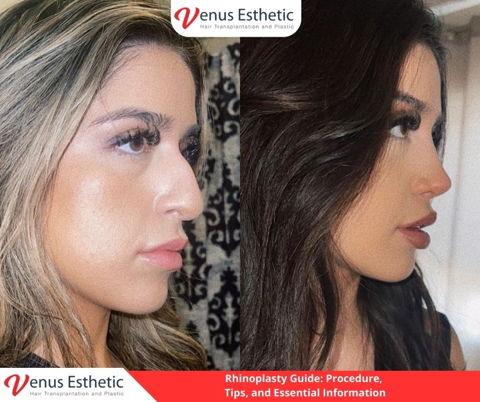 rhinoplasty, rhinoplasty near me, non surgical rhinoplasty, nose job near me, nose jobs, liquid rhinoplasty, non surgical rhinoplasty near me, non surgical rhinoplasty near me, nose plastic surgery, liquid rhinoplasty near me, nose thread lift, nose job price, liquid nose job, nose fillers, nose fillers near me, nose surgeons near me, liquid nose job near me, nose reconstruction surgery, closed rhinoplasty, septorhinoplasty, nose plastic surgery cost, non invasive nose job, venus turkey, venus esthetic clinic, Plastic Surgery, Rhinoplasty, Brazilian butt lift, botox, nose job istanbul, rhinoplasty istanbul, nose surgery istanbul, rhinoplasty turkey istanbul, best doctor in turkey, venus rihnoplasty, venus clinic turkey, best rhinoplasty doctor in turkey, best rhinoplasty doctor in usa, best rhinoplasty doctor in uk, venus esthetic clinic, vera clinic, turkeyana clinic, olcay saygin, dr zen hair, dr cinik, venus clinic turkey, Brazilian butt lift usa, Brazilian butt lift uk, Brazilian butt lift turkey, Brazilian Butt Lift, best Brazilian Butt Lift doctor in usa, best Brazilian Butt Lift doctor in uk, best Brazilian Butt Lift doctor in turkey, best Brazilian Butt Lift doctor in australia, best Plastic Surgery doctor in Turkey, best Plastic Surgery doctor in usa, best Plastic Surgery doctor in uk, best clinic in Turkey, best clinic in usa, best clinic in uk, best doctor in usa, best doctor in uk, best doctor in canada