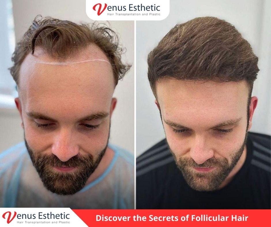 Hair Angle, Hair Plantation, Hairline Transplant Cost, hair transplant, hair transplant turkey, venus hair transplant, euro zen hair, best doctor in turkey, best clinic in turkey, hair transplant result, clinic expert, hair transplant, hair transplant uk, dr serkan aygin, hair transplant surgery, dr cinik, dr zen hair, best doctor in turkey, usa hair transplant, dr zen, euro hair transplant, hair transplant cost, hair transplant in usa, hair transplant in uk, hair transplant in australia, hair transplant australia, hair replacement cost, UK vs Turkey Hair Transplant Procedures, venus esthetic clinic, best hair transplant doctor in turkey, turkish hair transplant, Hair Transplants in Turkey, neograft hair transplant near me, hairline transplant, hair plugs cost, fue hair transplant, conor mcgregor hair transplant, Choi Implanter, follicular hair