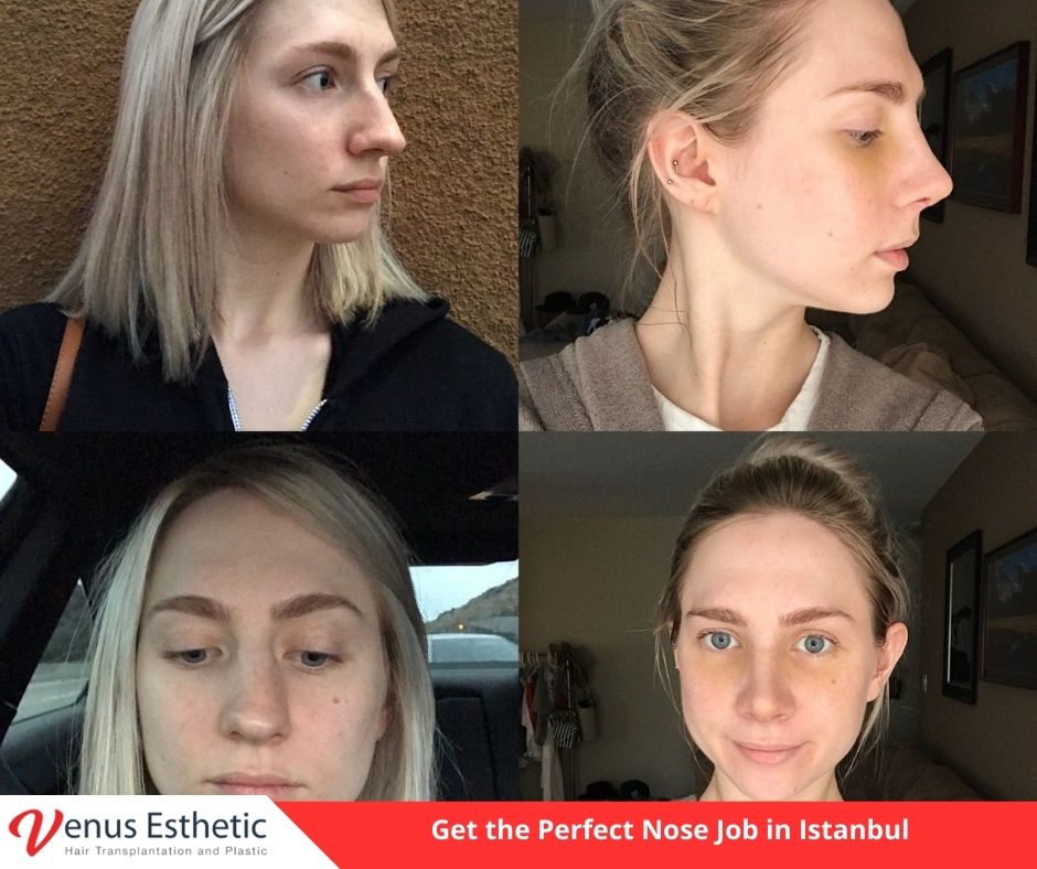 nose job istanbul, rhinoplasty istanbul, nose surgery istanbul, rhinoplasty turkey istanbul, rhinoplasty in istanbul turkey, best doctro in turkey, venus rihnoplasty, venus clinic turkey, best rhinoplasty doctor in turkey, best rhinoplasty doctor in usa, best rhinoplasty doctor in uk