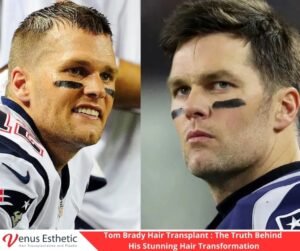 Tom Brady Hair Transplant: Did He Really Get One? Before & After Revealed!
