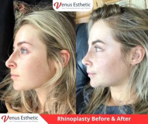 rhinoplasty, rhinoplasty near me, non surgical rhinoplasty, nose job near me, nose jobs, liquid rhinoplasty, non surgical rhinoplasty near me, non surgical rhinoplasty near me, nose plastic surgery, liquid rhinoplasty near me, nose thread lift, nose job price, liquid nose job, nose fillers, nose fillers near me, nose surgeons near me, liquid nose job near me, nose reconstruction surgery, closed rhinoplasty, septorhinoplasty, nose plastic surgery cost, non invasive nose job, venus turkey, venus esthetic clinic, Plastic Surgery, Rhinoplasty, Brazilian butt lift, botox, nose job istanbul, rhinoplasty istanbul, nose surgery istanbul, rhinoplasty turkey istanbul, best doctor in turkey, venus rihnoplasty, venus clinic turkey, best rhinoplasty doctor in turkey, best rhinoplasty doctor in usa, best rhinoplasty doctor in uk, venus esthetic clinic, vera clinic, turkeyana clinic, olcay saygin, dr zen hair, dr cinik, venus clinic turkey, Brazilian butt lift usa, Brazilian butt lift uk, Brazilian butt lift turkey, Brazilian Butt Lift, best Brazilian Butt Lift doctor in usa, best Brazilian Butt Lift doctor in uk, best Brazilian Butt Lift doctor in turkey, best Brazilian Butt Lift doctor in australia, best Plastic Surgery doctor in Turkey, best Plastic Surgery doctor in usa, best Plastic Surgery doctor in uk, best clinic in Turkey, best clinic in usa, best clinic in uk, best doctor in usa, best doctor in uk, best doctor in canada