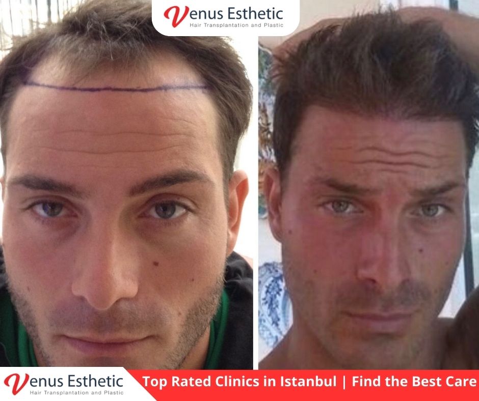 best clinic istanbul, Hair Angle, Hair Plantation, Hairline Transplant Cost, hair transplant, hair transplant turkey, venus hair transplant, euro zen hair, best doctor in turkey, best clinic in turkey, hair transplant result, clinic expert, hair transplant, hair transplant uk, dr serkan aygin, hair transplant surgery, dr cinik, dr zen hair, best doctor in turkey, usa hair transplant, dr zen, euro hair transplant, hair transplant cost, hair transplant in usa, hair transplant in uk, hair transplant in australia, hair transplant australia, hair replacement cost, UK vs Turkey Hair Transplant Procedures, venus esthetic clinic, best hair transplant doctor in turkey, turkish hair transplant, Hair Transplants in Turkey, neograft hair transplant near me, hairline transplant, hair plugs cost, fue hair transplant, conor mcgregor hair transplant, Choi Implanter, follicular hair, olcay saygin