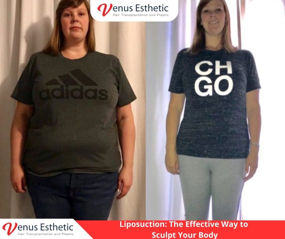 Liposuction, fillers, Plastic Surgery, Rhinoplasty, Brazilian butt lift, botox, nose job istanbul, rhinoplasty istanbul, nose surgery istanbul, rhinoplasty turkey istanbul, best doctor in turkey, venus rihnoplasty, venus clinic turkey, best rhinoplasty doctor in turkey, best rhinoplasty doctor in usa, best rhinoplasty doctor in uk, venus esthetic clinic, vera clinic, turkeyana clinic, olcay saygin, dr zen hair, dr cinik, venus clinic turkey, Brazilian butt lift usa, Brazilian butt lift uk, Brazilian butt lift turkey, Brazilian Butt Lift, best Brazilian Butt Lift doctor in usa, best Brazilian Butt Lift doctor in uk, best Brazilian Butt Lift doctor in turkey, best Brazilian Butt Lift doctor in australia, best Plastic Surgery doctor in Turkey, best Plastic Surgery doctor in usa, best Plastic Surgery doctor in uk, best clinic in Turkey, best clinic in usa, best clinic in uk, best doctor in usa, best doctor in uk, best doctor in canada, Breast augmentation, best clinic istanbul
