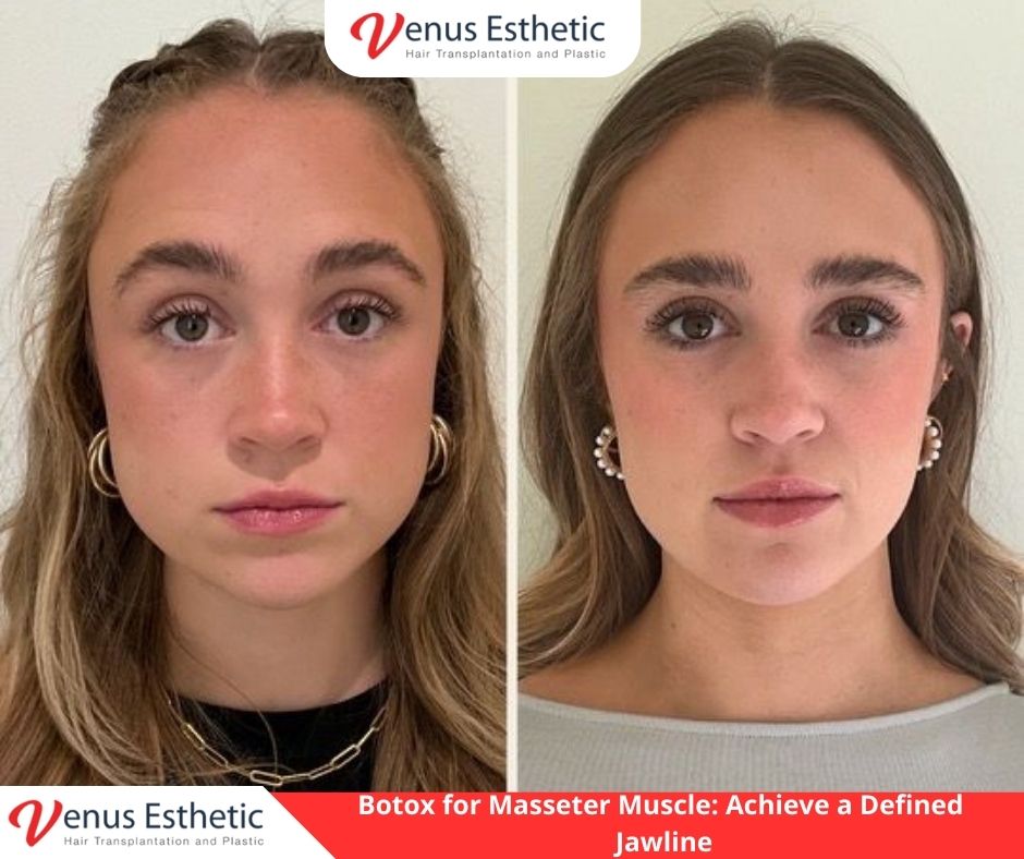 masseter botox, Liposuction, fillers, Plastic Surgery, Rhinoplasty, Brazilian butt lift, botox, nose job istanbul, rhinoplasty istanbul, nose surgery istanbul, rhinoplasty turkey istanbul, best doctor in turkey, venus rihnoplasty, venus clinic turkey, best rhinoplasty doctor in turkey, best rhinoplasty doctor in usa, best rhinoplasty doctor in uk, venus esthetic clinic, vera clinic, turkeyana clinic, olcay saygin, dr zen hair, dr cinik, venus clinic turkey, Brazilian butt lift usa, Brazilian butt lift uk, Brazilian butt lift turkey, Brazilian Butt Lift, best Brazilian Butt Lift doctor in usa, best Brazilian Butt Lift doctor in uk, best Brazilian Butt Lift doctor in turkey, best Brazilian Butt Lift doctor in australia, best Plastic Surgery doctor in Turkey, best Plastic Surgery doctor in usa, best Plastic Surgery doctor in uk, best clinic in Turkey, best clinic in usa, best clinic in uk, best doctor in usa, best doctor in uk, best doctor in canada, Breast augmentation, best clinic istanbul