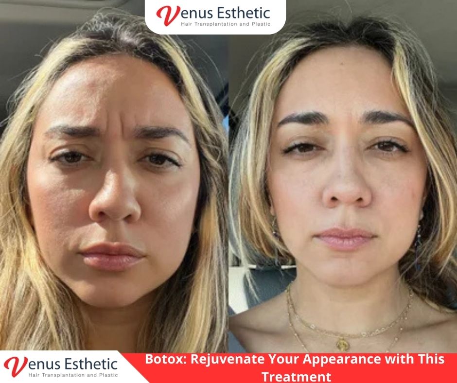 masseter botox, Liposuction, fillers, Plastic Surgery, Rhinoplasty, Brazilian butt lift, botox, nose job istanbul, rhinoplasty istanbul, nose surgery istanbul, rhinoplasty turkey istanbul, best doctor in turkey, venus rihnoplasty, venus clinic turkey, best rhinoplasty doctor in turkey, best rhinoplasty doctor in usa, best rhinoplasty doctor in uk, venus esthetic clinic, vera clinic, turkeyana clinic, olcay saygin, dr zen hair, dr cinik, venus clinic turkey, Brazilian butt lift usa, Brazilian butt lift uk, Brazilian butt lift turkey, Brazilian Butt Lift, best Brazilian Butt Lift doctor in usa, best Brazilian Butt Lift doctor in uk, best Brazilian Butt Lift doctor in turkey, best Brazilian Butt Lift doctor in australia, best Plastic Surgery doctor in Turkey, best Plastic Surgery doctor in usa, best Plastic Surgery doctor in uk, best clinic in Turkey, best clinic in usa, best clinic in uk, best doctor in usa, best doctor in uk, best doctor in canada, Breast augmentation, best clinic istanbul