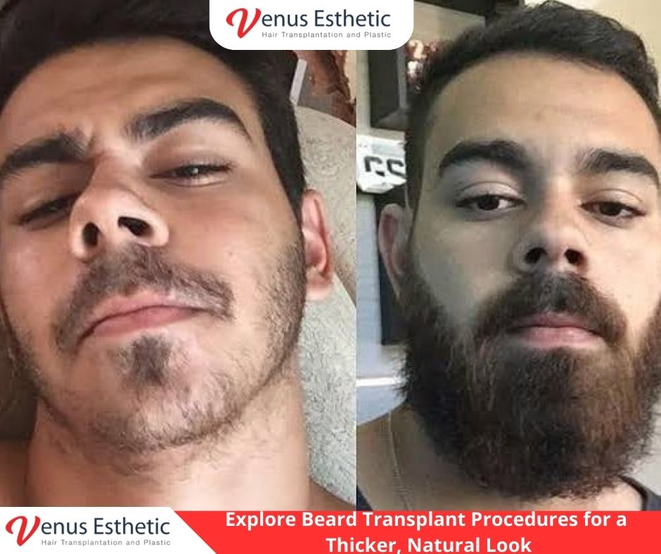 Beard Transplant, Best Hair Transplant in Turkey, best clinic istanbul, Hair Angle, Hair Plantation, Hairline Transplant Cost, hair transplant, hair transplant turkey, venus hair transplant, euro zen hair, best doctor in turkey, best clinic in turkey, hair transplant result, clinic expert, hair transplant, hair transplant uk, dr serkan aygin, hair transplant surgery, dr cinik, dr zen hair, best doctor in turkey, usa hair transplant, dr zen, euro hair transplant, hair transplant cost, hair transplant in usa, hair transplant in uk, hair transplant in australia, hair transplant australia, hair replacement cost, UK vs Turkey Hair Transplant Procedures, venus esthetic clinic, best hair transplant doctor in turkey, turkish hair transplant, Hair Transplants in Turkey, neograft hair transplant near me, hairline transplant, hair plugs cost, fue hair transplant, conor mcgregor hair transplant, Choi Implanter, follicular hair, olcay saygin