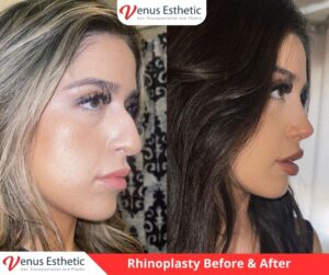 rhinoplasty, rhinoplasty near me, non surgical rhinoplasty, nose job near me, nose jobs, liquid rhinoplasty, non surgical rhinoplasty near me, non surgical rhinoplasty near me, nose plastic surgery, liquid rhinoplasty near me, nose thread lift, nose job price, liquid nose job, nose fillers, nose fillers near me, nose surgeons near me, liquid nose job near me, nose reconstruction surgery, closed rhinoplasty, septorhinoplasty, nose plastic surgery cost, non invasive nose job, venus turkey, venus esthetic clinic, Plastic Surgery, Rhinoplasty, Brazilian butt lift, botox, nose job istanbul, rhinoplasty istanbul, nose surgery istanbul, rhinoplasty turkey istanbul, best doctor in turkey, venus rihnoplasty, venus clinic turkey, best rhinoplasty doctor in turkey, best rhinoplasty doctor in usa, best rhinoplasty doctor in uk, venus esthetic clinic, vera clinic, turkeyana clinic, olcay saygin, dr zen hair, dr cinik, venus clinic turkey, Brazilian butt lift usa, Brazilian butt lift uk, Brazilian butt lift turkey, Brazilian Butt Lift, best Brazilian Butt Lift doctor in usa, best Brazilian Butt Lift doctor in uk, best Brazilian Butt Lift doctor in turkey, best Brazilian Butt Lift doctor in australia, best Plastic Surgery doctor in Turkey, best Plastic Surgery doctor in usa, best Plastic Surgery doctor in uk, best clinic in Turkey, best clinic in usa, best clinic in uk, best doctor in usa, best doctor in uk, best doctor in canada