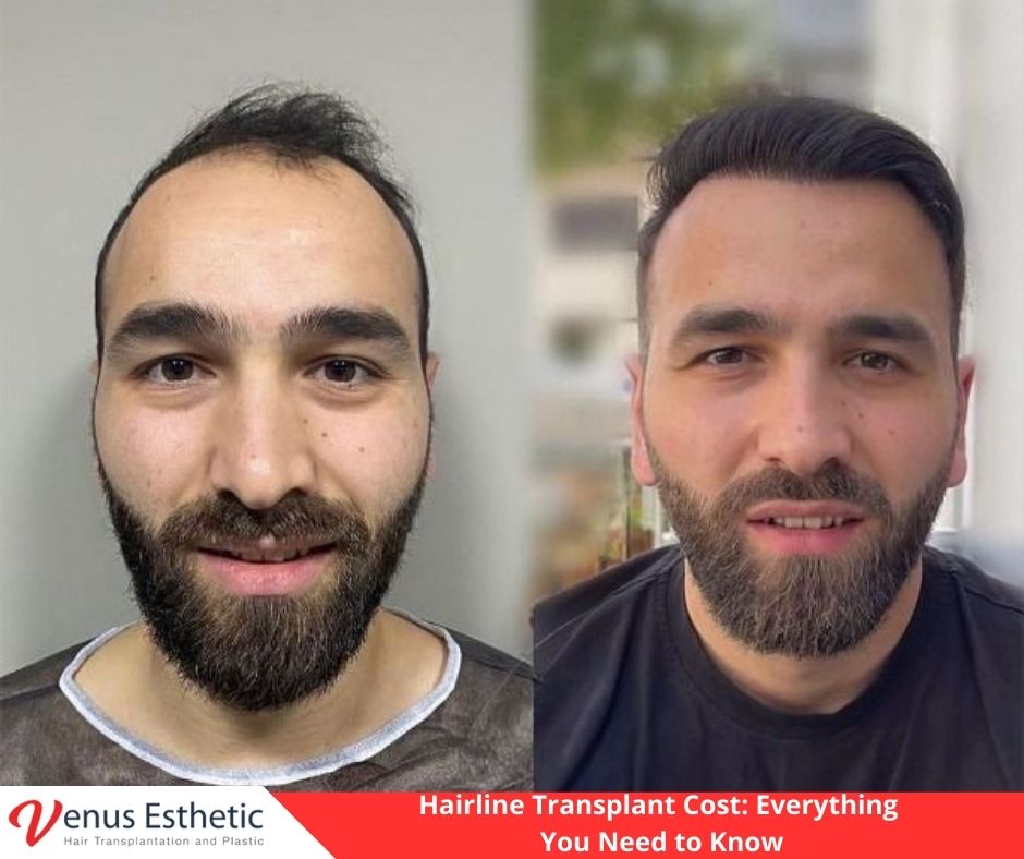 Hairline Transplant Cost, hair transplant, hair transplant in turkey, best hair transplant clinic in Turkey, best hair transplant doctor in turkey, hair transplant cost