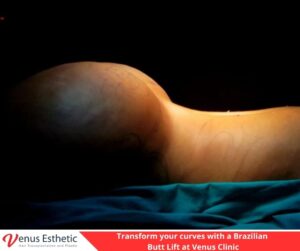Plastic Surgery, Rhinoplasty, Brazilian butt lift, botox, nose job istanbul, rhinoplasty istanbul, nose surgery istanbul, rhinoplasty turkey istanbul, best doctro in turkey, venus rihnoplasty, venus clinic turkey, best rhinoplasty doctor in turkey, best rhinoplasty doctor in usa, best rhinoplasty doctor in uk, venus esthetic clinic, vera clinic, turkeyana clinic, olcay saygin, dr zen hair, dr cinik, venus clinic turkey, Brazilian butt lift usa, Brazilian butt lift uk, Brazilian butt lift turkey, Brazilian Butt Lift