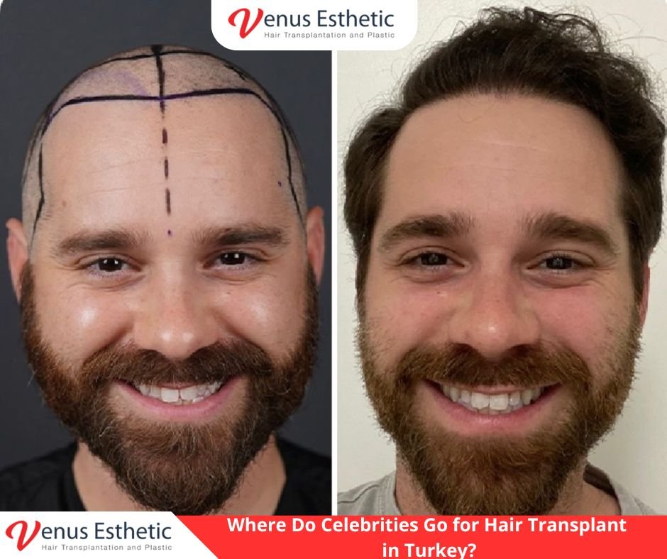 Celebrity hair transplant Turkey VIP results Venus Pro Esthetic Clinic, secret hair transplant of famous people Istanbul, best clinic for celebrity hair restoration Turkey, doctor performing VIP hair transplant A to Z, Venus Pro Esthetic Clinic luxury recovery suites, natural hair transplant results for public figures Turkey