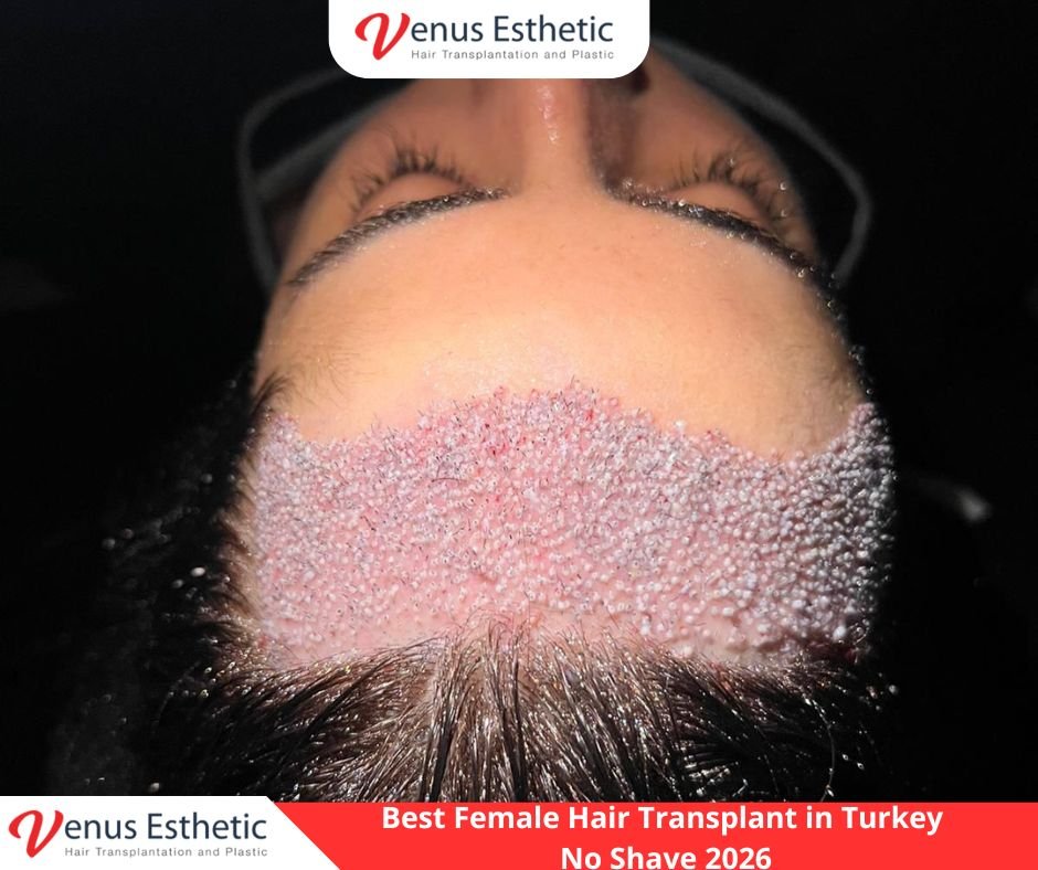 Female hair transplant Turkey no shave results Venus Pro Esthetic Clinic, Best clinic for female hair restoration in Istanbul doctor performing surgery, Natural hairline design for women at Venus Pro Esthetic Clinic Turkey, DHI hair transplant for women without shaving Istanbul 2026, Venus Pro Esthetic Clinic doctor-led hair transplant from A to Z, Long hair transplant for women Turkey before and after results, Top rated female hair transplant clinic in Istanbul Venus Pro Esthetic.