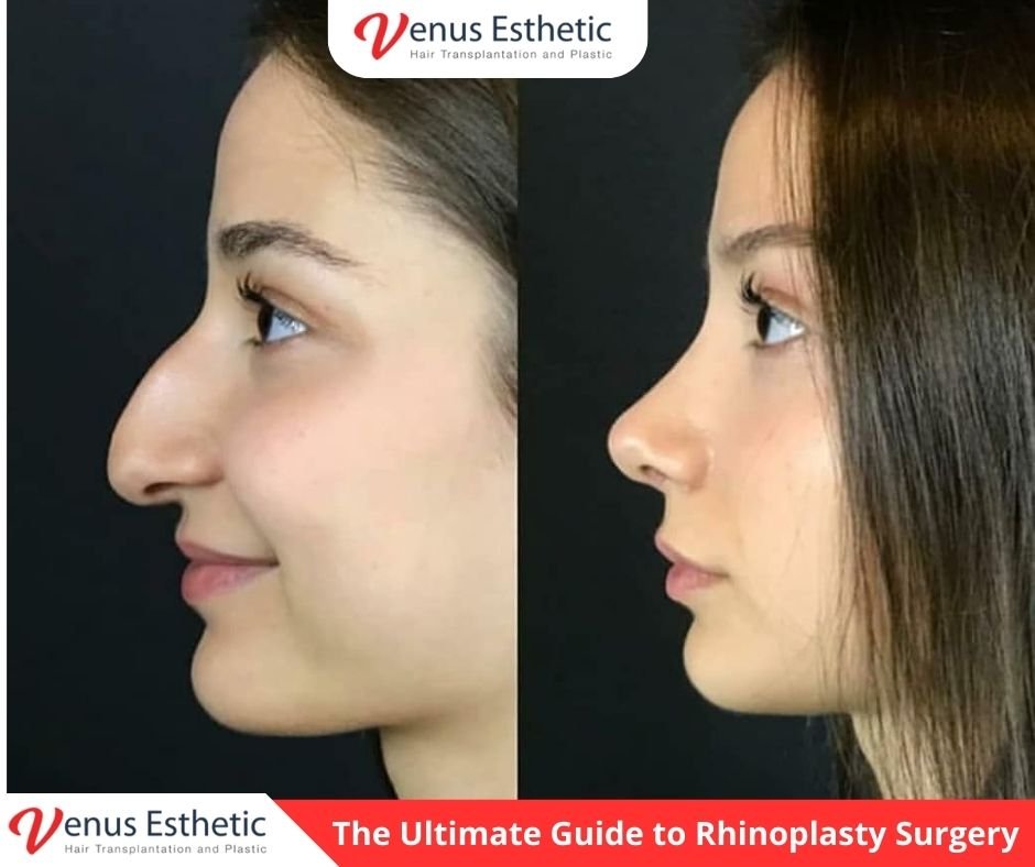 Rhinoplasty surgery, Nose job cost, Best rhinoplasty surgeon, Septoplasty, Ultrasonic rhinoplasty, Cosmetic nose surgery, Rhinoplasty recovery tips, Deviated septum correction, Before and after rhinoplasty, Venus Pro Esthetic, Nose reshaping, Surgical rhinoplasty, Non-surgical nose job, Facial symmetry, Nasal bridge reduction, Tip plastly, Rhinoplasty consultation, Nose surgery results, Plastic surgery clinic, Natural looking rhinoplasty