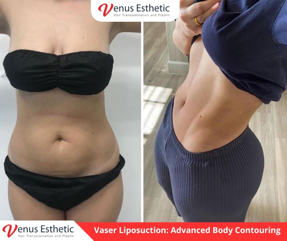 Vaser Liposuction, Body contouring surgery, Ultrasound fat removal, High definition lipo, Venus Pro Esthetic, Fat removal results, Liposuction recovery tips, Vaser lipo before and after, Skin tightening after lipo, Abdominal etching, Vaser technology, Cosmetic surgery clinic, Minimally invasive fat removal, Lipo for men, Stubborn fat treatment, Vaser lipo price, Precision body sculpting, Safe fat removal, Vaser vs Traditional lipo, Body transformation.